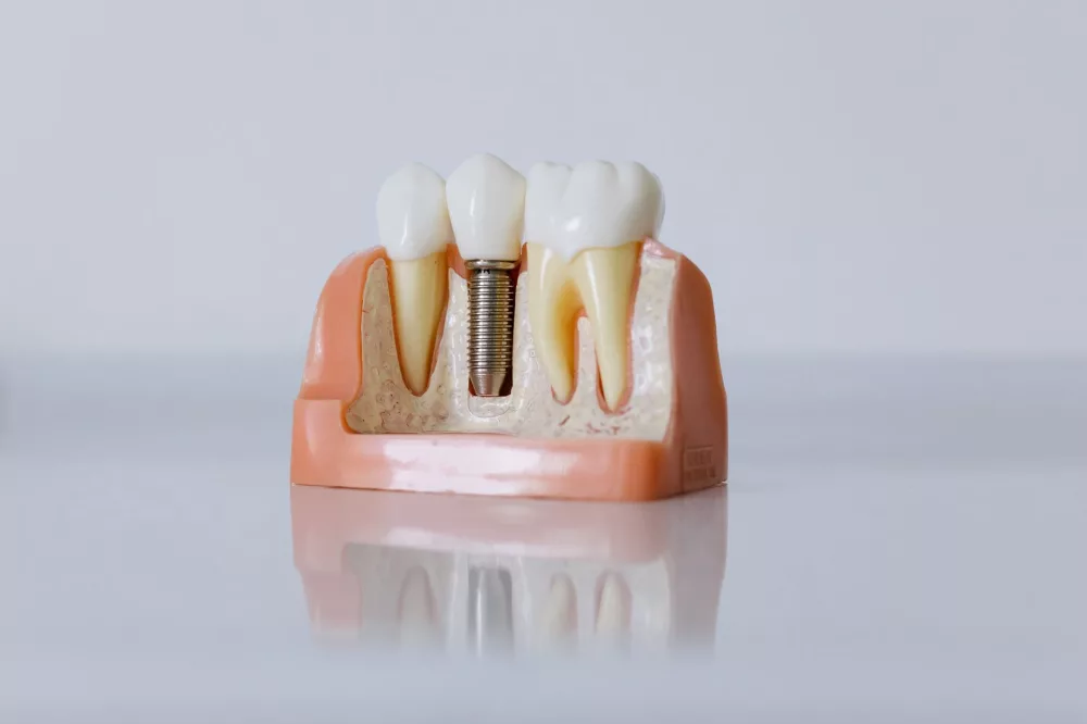 ClearChoice Dental Implants: A Detailed Look at Restoring Your Smile